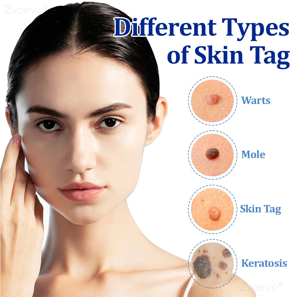 đŠââď¸ZvoevoÂŽ BeeDerm RX Cream, Painless, easy and gentle fix for warts, skin tags, lumps, infections, cysts and scars
