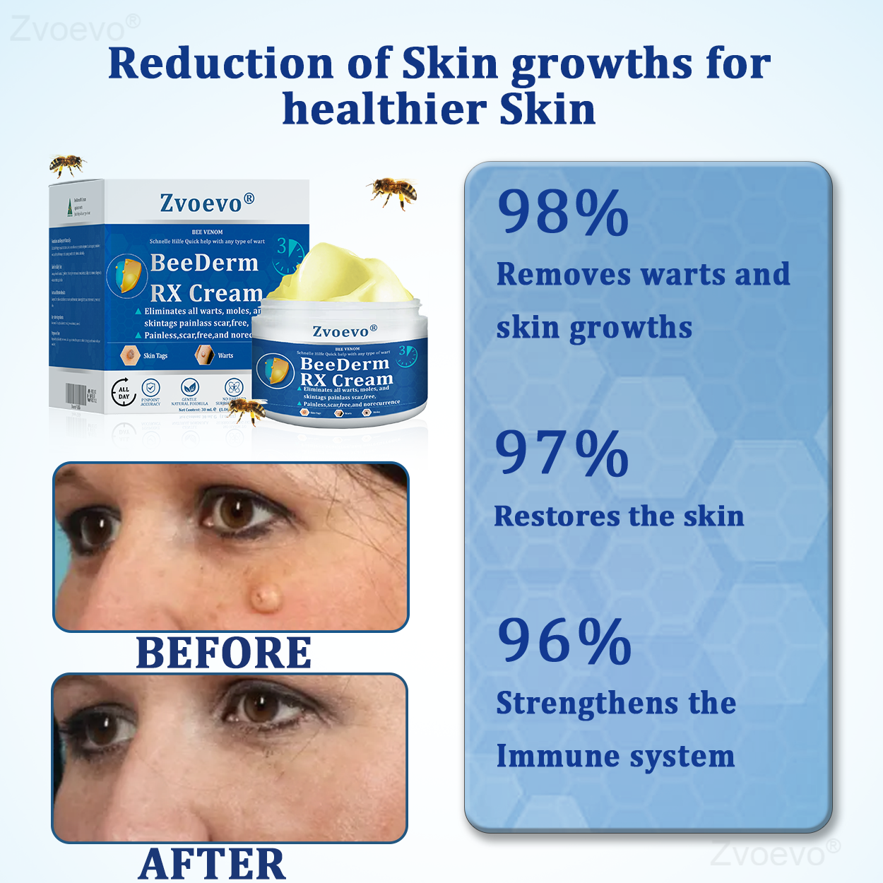 đŠââď¸ZvoevoÂŽ BeeDerm RX Cream, Painless, easy and gentle fix for warts, skin tags, lumps, infections, cysts and scars