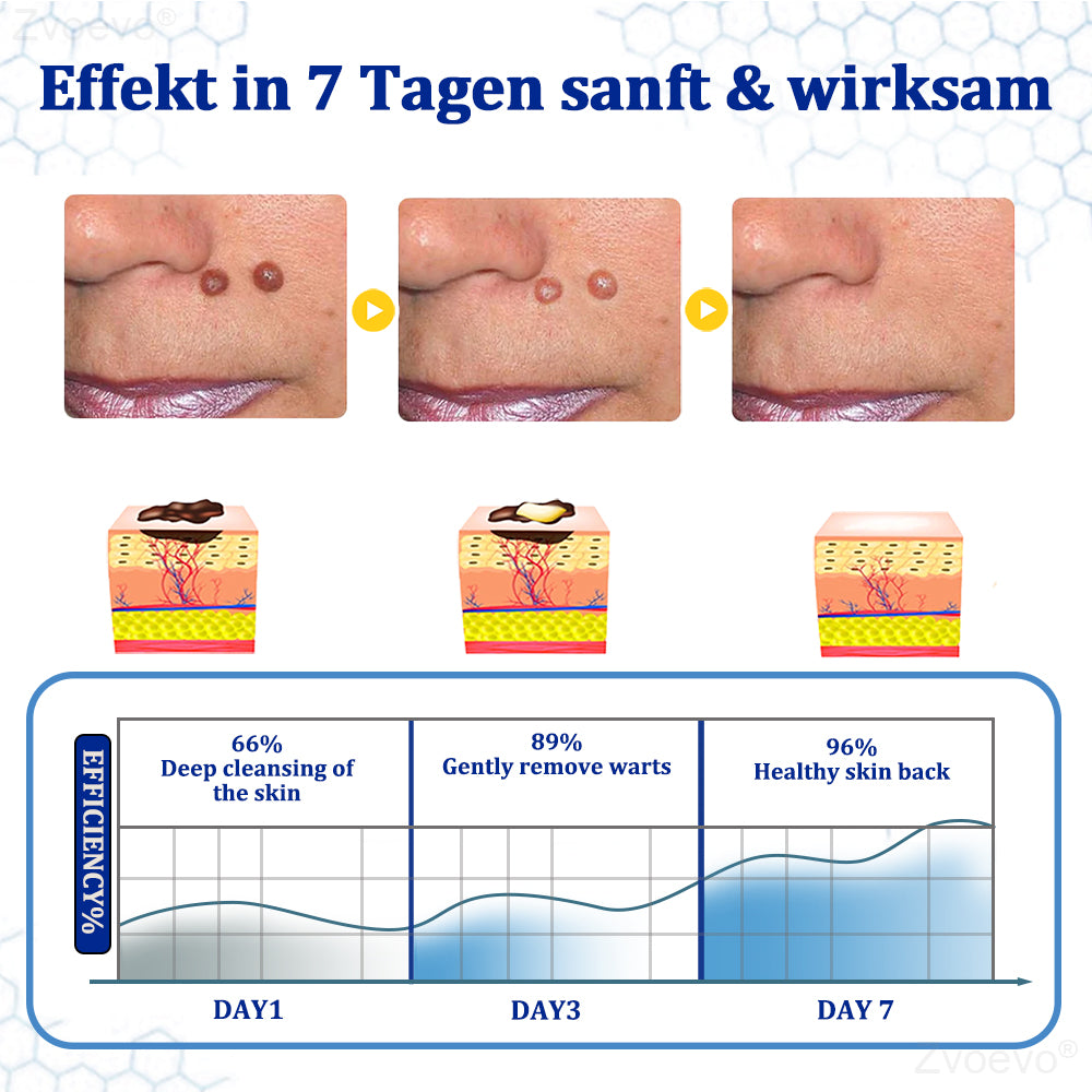 đŠââď¸ZvoevoÂŽ BeeDerm RX Cream, Painless, easy and gentle fix for warts, skin tags, lumps, infections, cysts and scars