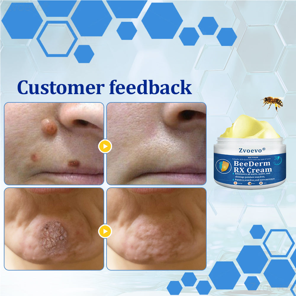 đŠââď¸ZvoevoÂŽ BeeDerm RX Cream, Painless, easy and gentle fix for warts, skin tags, lumps, infections, cysts and scars