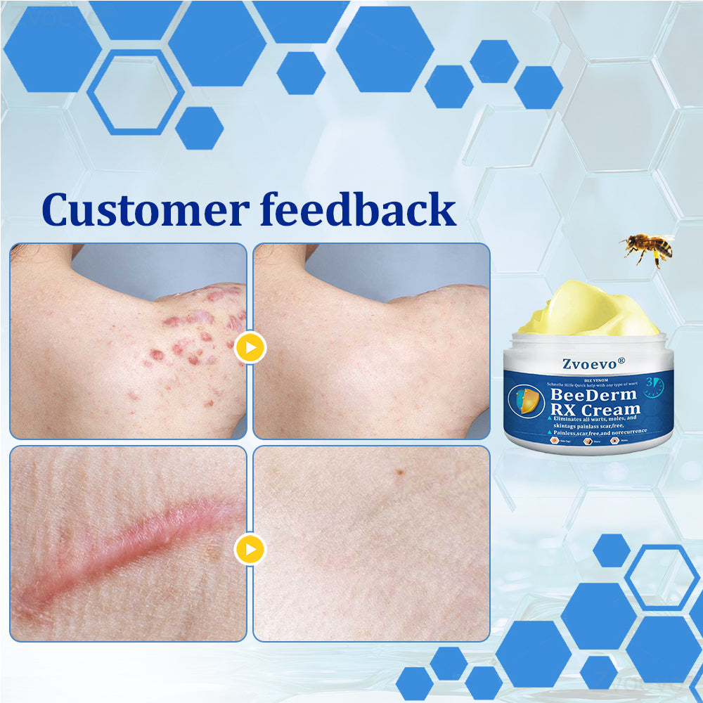 đŠââď¸ZvoevoÂŽ BeeDerm RX Cream, Painless, easy and gentle fix for warts, skin tags, lumps, infections, cysts and scars