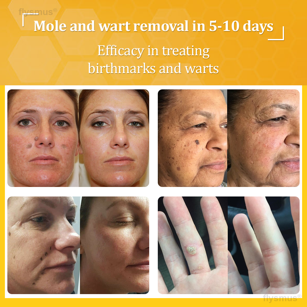 🎁flysmus® BeeDerm RX Cream, Painless, Targeted Treatment for Warts, Skin Tags, Skin Lesions, Infections, and Scars