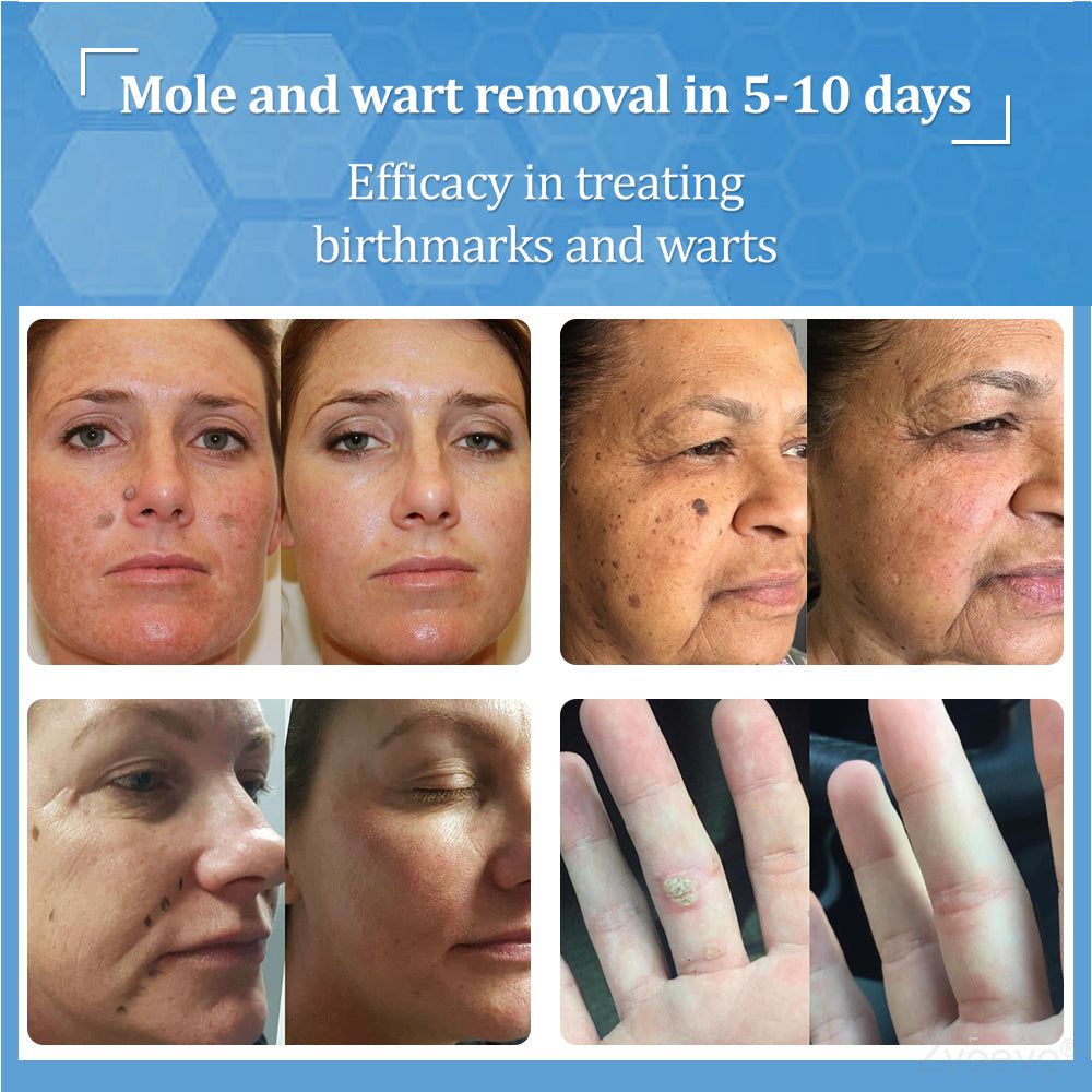 đŠââď¸ZvoevoÂŽ BeeDerm RX Cream, Painless, easy and gentle fix for warts, skin tags, lumps, infections, cysts and scars
