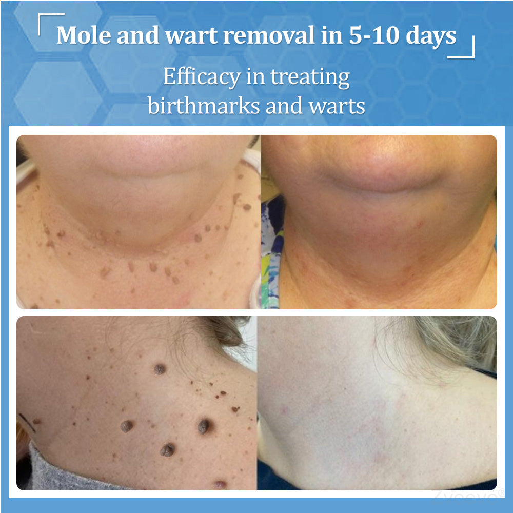 đŠââď¸ZvoevoÂŽ BeeDerm RX Cream, Painless, easy and gentle fix for warts, skin tags, lumps, infections, cysts and scars