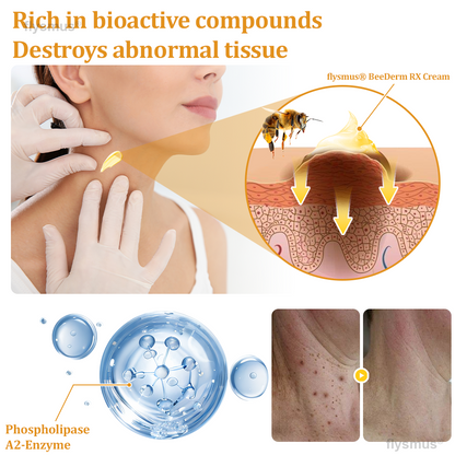 👍flysmus® BeeDerm RX Cream, Painless, Targeted Treatment for Warts, Skin Tags, Skin Lesions, Infections, and Scars