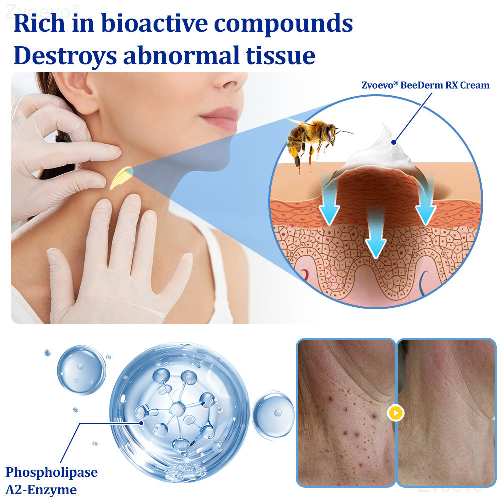 👩‍⚕️Zvoevo® BeeDerm RX Cream, Painless, easy and gentle fix for warts, skin tags, lumps, infections, cysts and scars