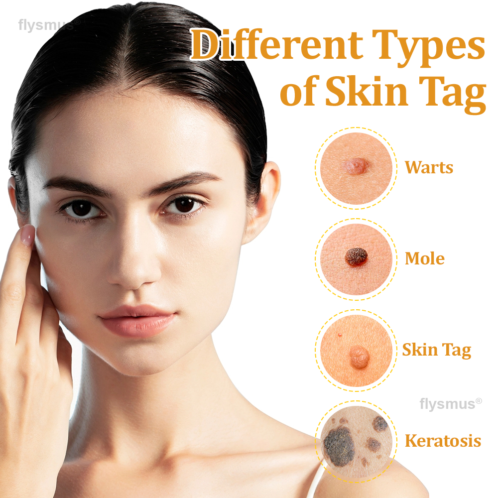 👍flysmus® BeeDerm RX Cream, Painless, Targeted Treatment for Warts, Skin Tags, Skin Lesions, Infections, and Scars