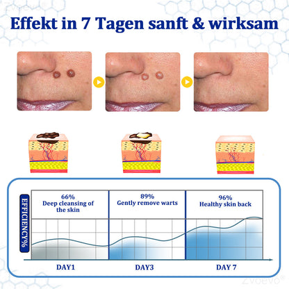 👩‍⚕️Zvoevo® BeeDerm RX Cream, Painless, easy and gentle fix for warts, skin tags, lumps, infections, cysts and scars