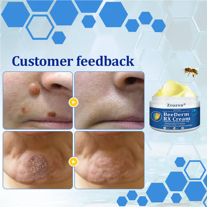 👩‍⚕️Zvoevo® BeeDerm RX Cream, Painless, easy and gentle fix for warts, skin tags, lumps, infections, cysts and scars