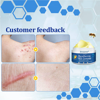 👩‍⚕️Zvoevo® BeeDerm RX Cream, Painless, easy and gentle fix for warts, skin tags, lumps, infections, cysts and scars
